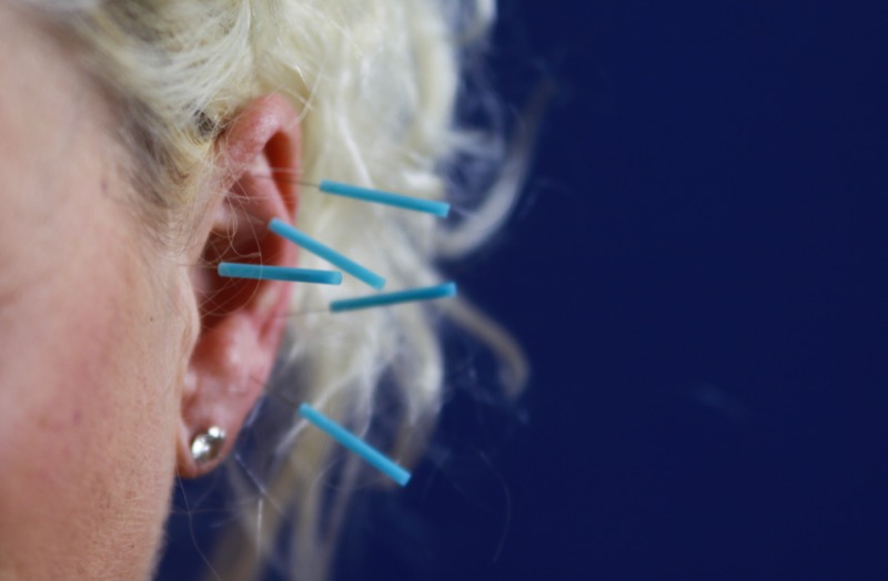 Auricular acupuncture also known as ear acupuncture, involves stimulating specific points on the ear.